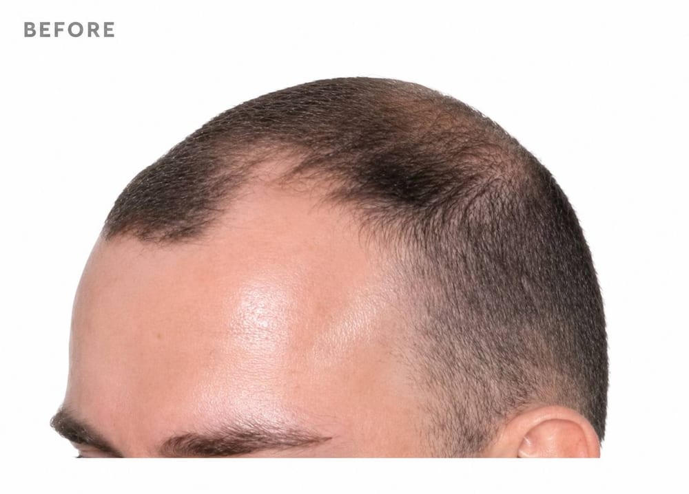 Hairline restoration — FUE result — before
