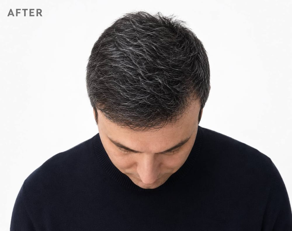 Hairline design & result — FUE — after