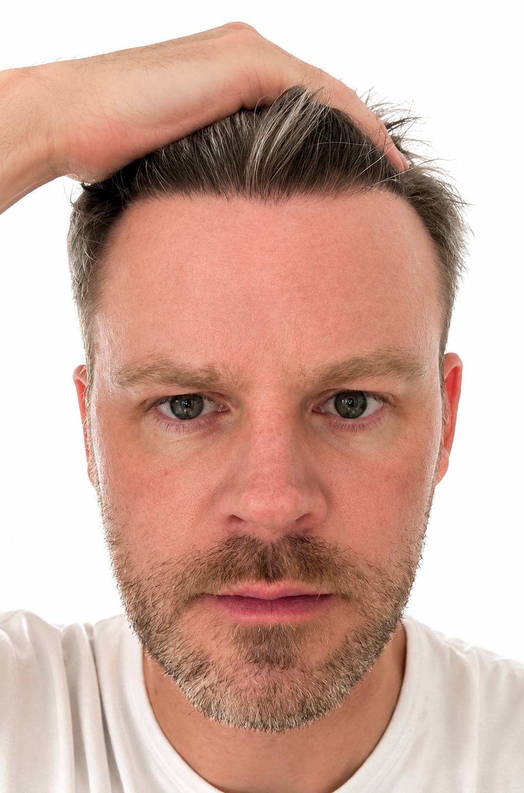 Hairline design & result — FUE — after