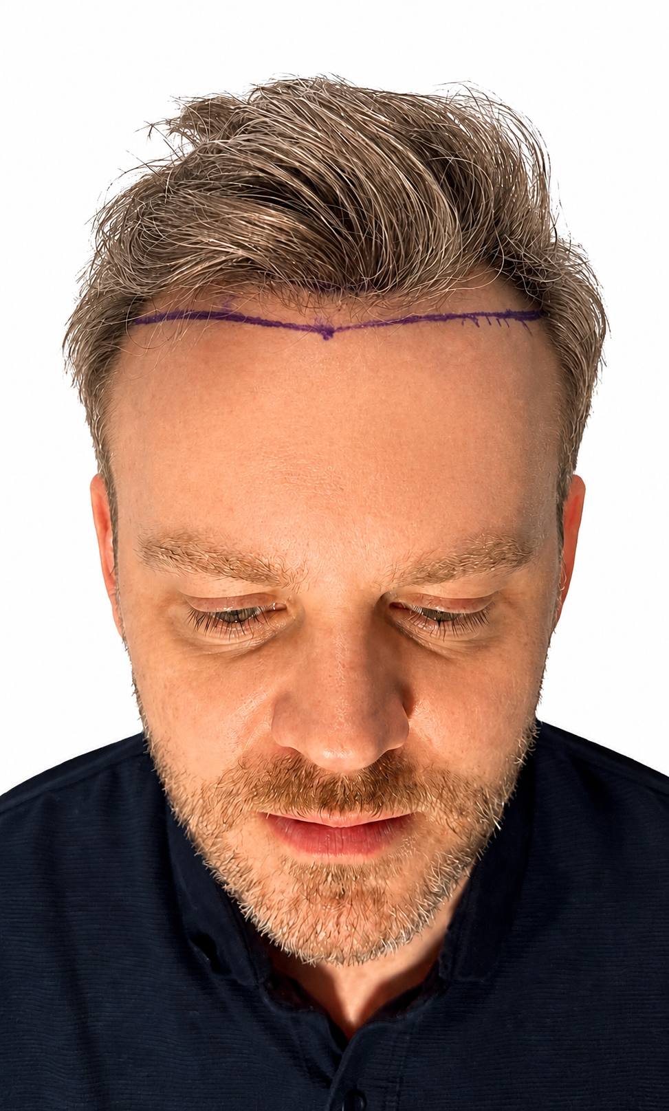 Hairline design & result — FUE — before