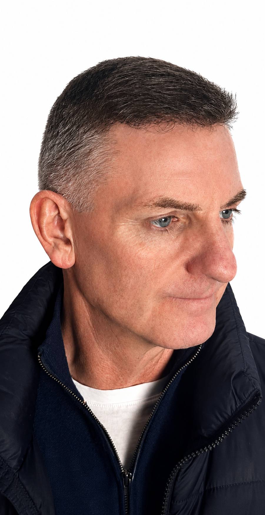 Receding hairline — FUE result — after