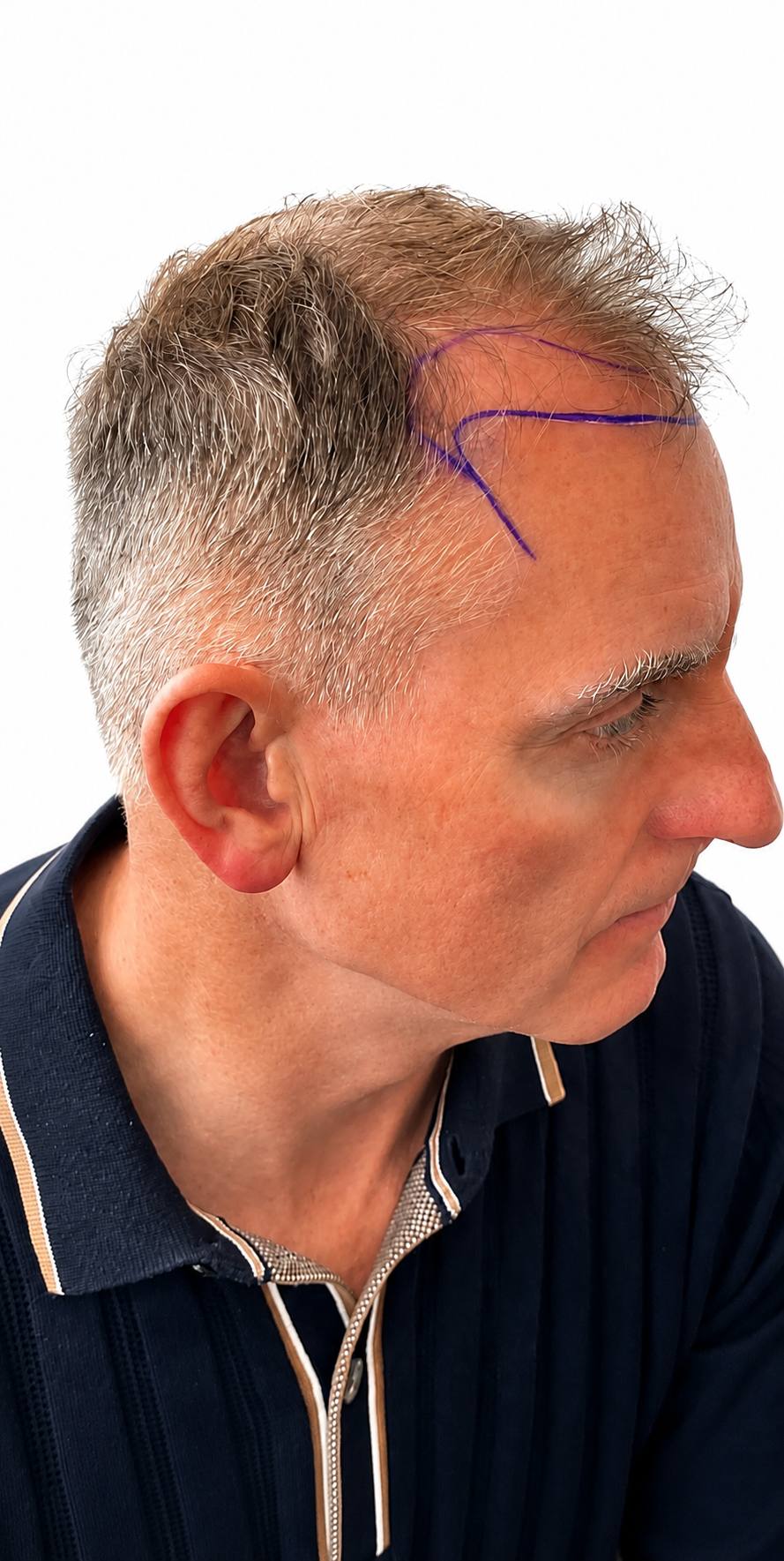 Receding hairline — FUE result — before
